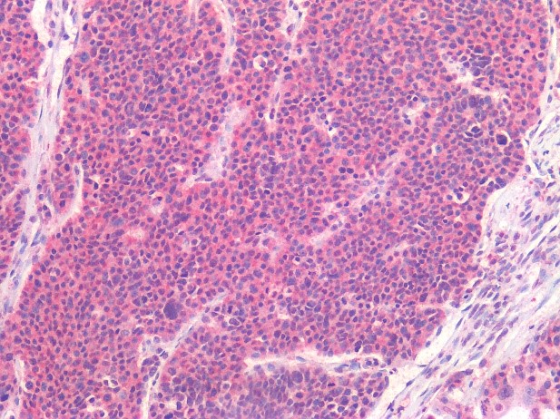 Figure 7. Immunostaining of human formalin fixed, paraffin embedded tissue section of a pancreatic carcinoid with 0566P (diluted 1:400), showing the specific pattern of NCAM/CD56 in the tumor cells.